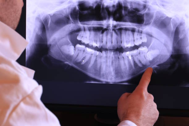 Best Emergency Dental Care for Broken or Chipped Teeth in Wellford, SC